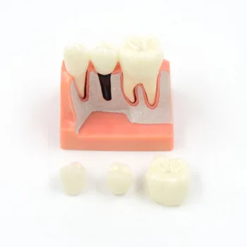 DARHMMY Dental Educira Analizi Implantata Odvojiva Model Корончатого mosta Demonstracija Model zuba Model implantata
